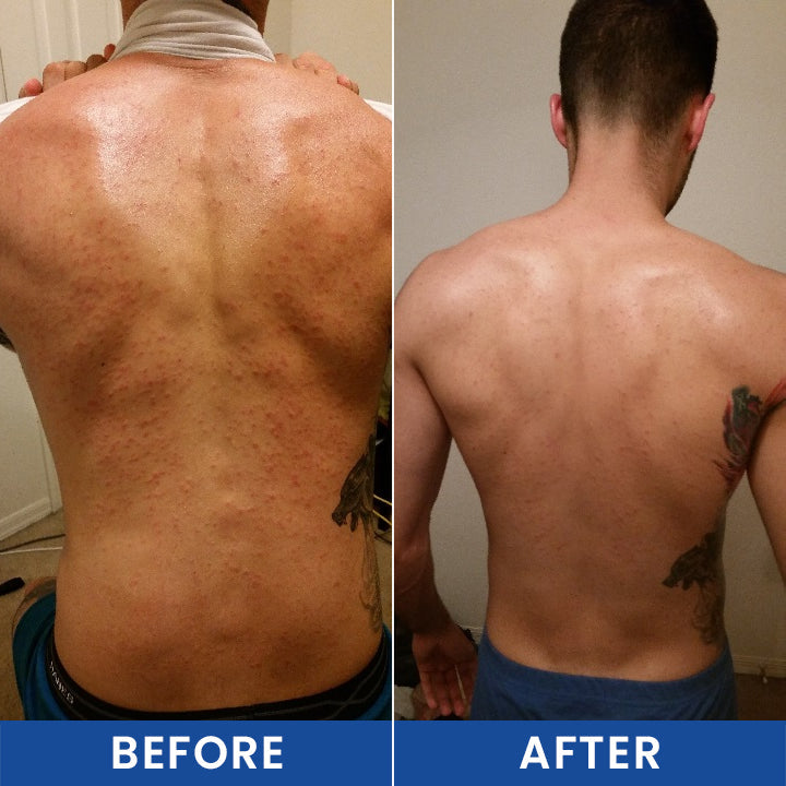 LIMETOW® Botanical Folliculitis Care Cream