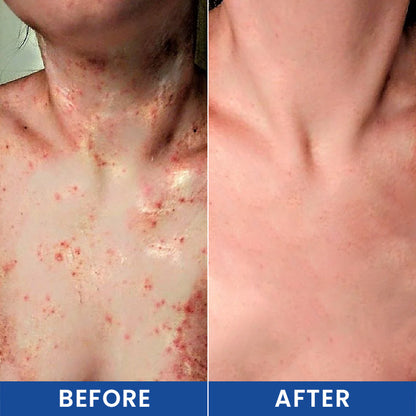 LIMETOW® Botanical Folliculitis Care Cream