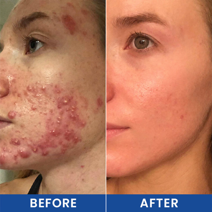 LIMETOW® Botanical Folliculitis Care Cream