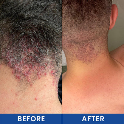 LIMETOW® Botanical Folliculitis Care Cream
